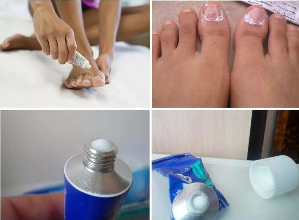 medicina per il fungo dell'unghia del piede