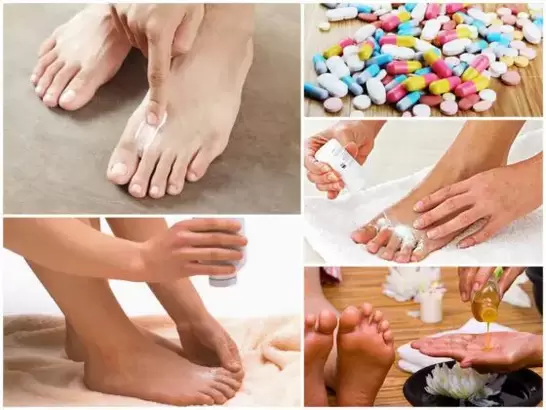 modi per trattare i funghi tra le dita dei piedi