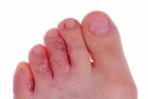 lesioni cutanee dovute a funghi sulle gambe